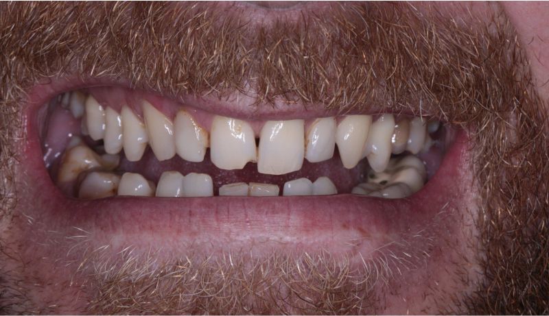 Восстановление зубов винирами и имплантами до