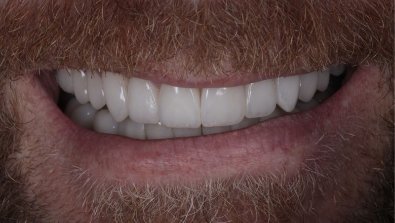 Восстановление зубов винирами и имплантами после