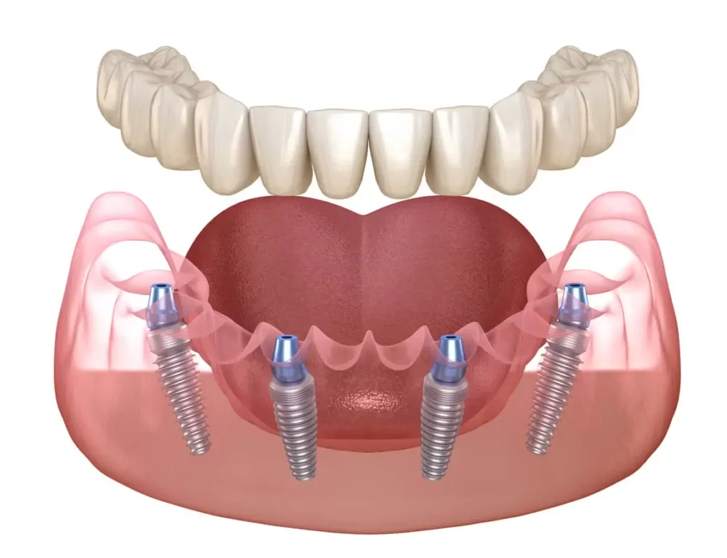 Имплантация зубов all 4 one