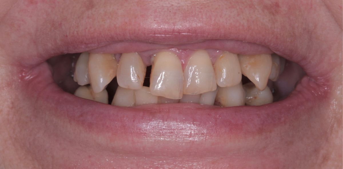Восстановление зубов винирами до